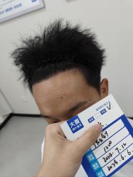 -大麦微针植发全国连锁