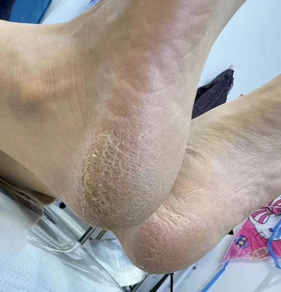 你知道为什么有那么多的人, 脚后跟会干裂有老茧?