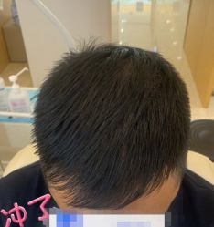 -大麦微针植发丨全国连锁