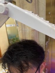 -碧莲盛·不剃发植发