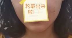 体验后-深圳美莱医疗美容医院