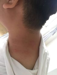 -爱莎扁平疣·汗管瘤·斑痣中心