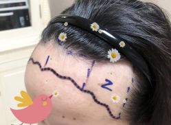 -大麦微针植发全国连锁