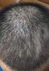 -大麦微针植发丨全国连锁