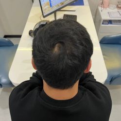 -大麦微针植发全国连锁