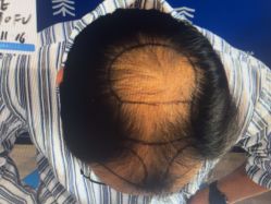 体验前-雍禾植发全国连锁