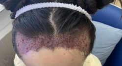 -大麦微针植发全国连锁