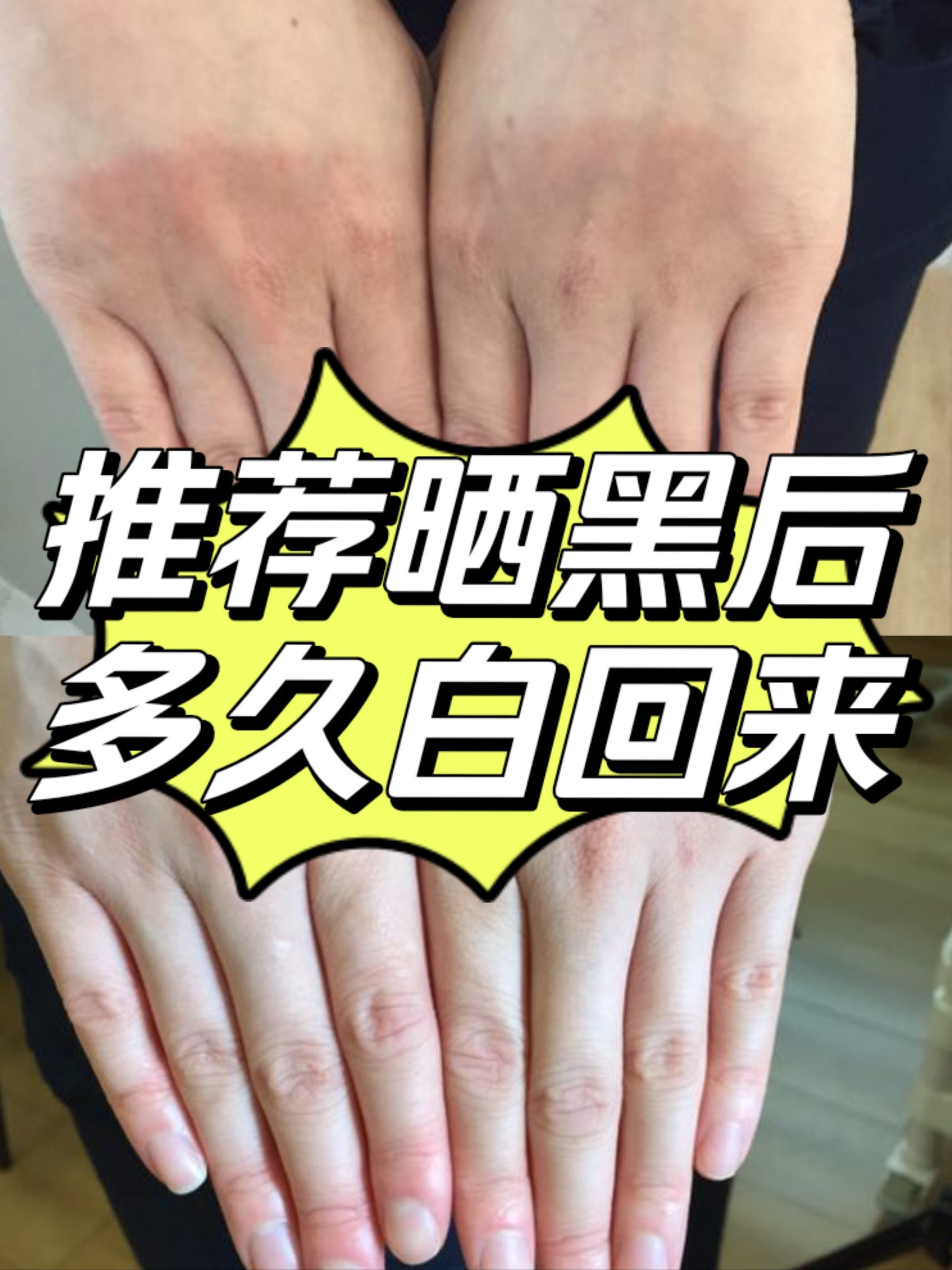😅那么晒黑后多久才能白回来呢?