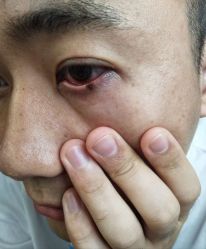 -北京美痣堂古方祛痣斑疣瘊