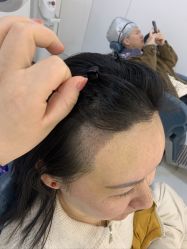 -大麦微针植发全国连锁