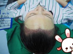 点击看大图 -大麦微针植发丨全国连锁