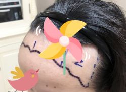 -大麦微针植发全国连锁