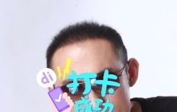 -大麦微针植发全国连锁