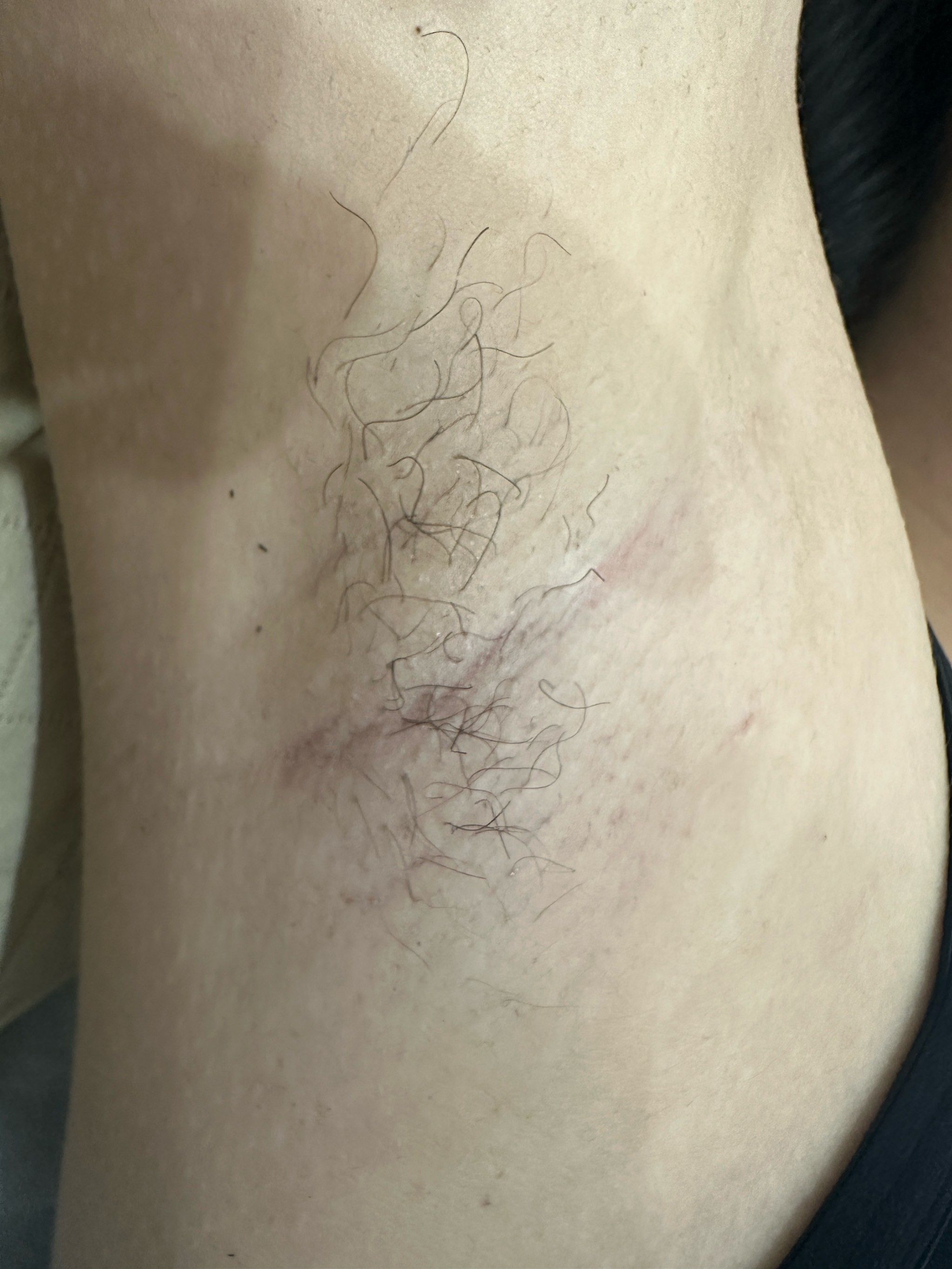 冰点脱毛7次为什么还长