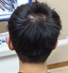 点击看大图 -大麦微针植发全国连锁