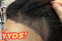 -大麦微针植发丨全国连锁