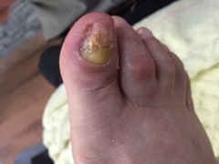 -祖传修脚甲沟炎灰指甲鸡眼