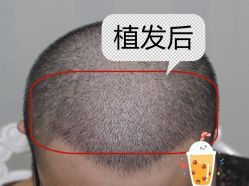-大麦微针植发全国连锁