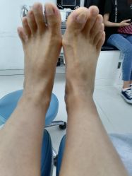 -派恩宜灰指甲鸡眼嵌甲手足癣