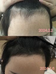 -菩叶脱发白发中心