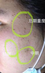 -美丽人生祛斑扁平疣汗管瘤中心