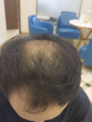 -碧莲盛·不剃发植发