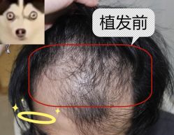 -大麦微针植发全国连锁