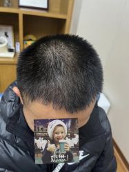 -大麦微针植发全国连锁