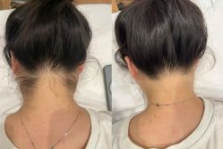 -薇兰专业脱毛连锁机构