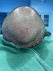 -大麦微针植发全国连锁