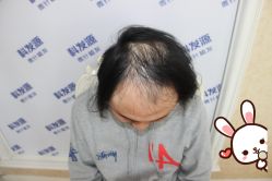 -大麦微针植发丨全国连锁