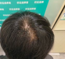 -碧莲盛·不剃发植发