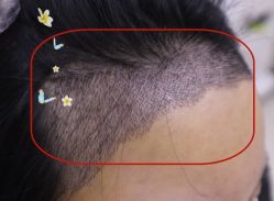 -大麦微针植发全国连锁