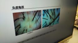 -碧莲盛·不剃发植发