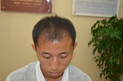 -大麦微针植发丨全国连锁