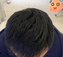 -大麦微针植发丨全国连锁