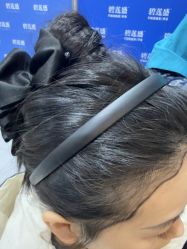 -碧莲盛不剃发植发