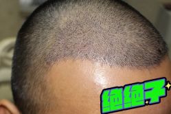 -大麦微针植发丨全国连锁