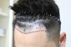 -熙朵美学植发·连锁品牌