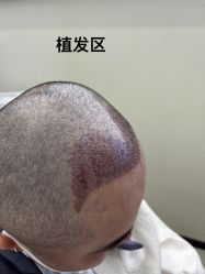 -大麦微针植发全国连锁