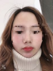 -溢美古法抗衰