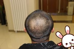 点击看大图 -大麦微针植发丨全国连锁