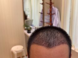 -碧莲盛·不剃发植发