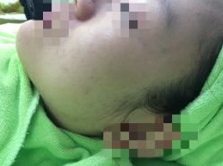 -苗医生草本科技祛痘