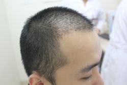 点击看大图 -大麦微针植发丨全国连锁