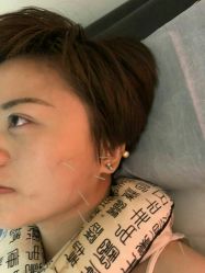-肥三针腧穴瘦身馆