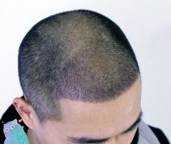 -大麦微针植发丨全国连锁