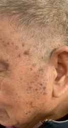 -瑶芳清颜草本祛痘