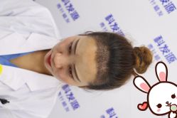 点击看大图 -大麦微针植发丨全国连锁