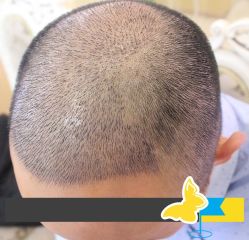 -大麦微针植发丨全国连锁